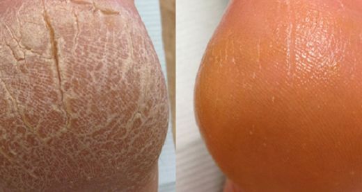 Evde Ayak Topuk Bakımı Nasıl Yapılır?